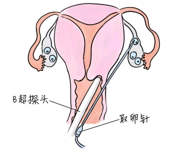 小儿退烧推拿手法 5种天津捐卵宝宝退烧按摩方法